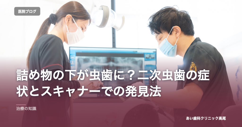 詰め物の下が虫歯に？二次虫歯の症状とスキャナーでの発見法 のアイキャッチ画像