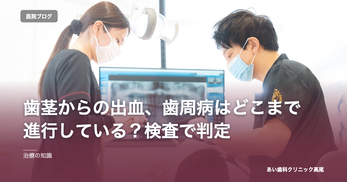 歯茎からの出血、歯周病はどこまで進行している？検査で判定 のアイキャッチ画像
