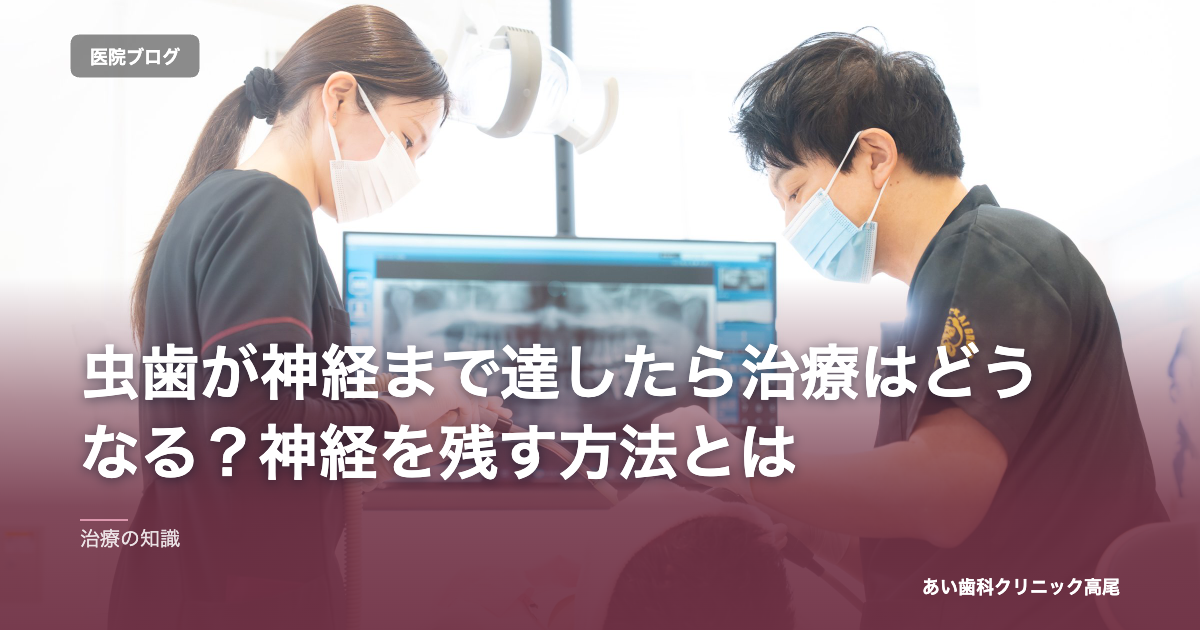 虫歯が神経まで達したら治療はどうなる？神経を残す方法とは のアイキャッチ画像