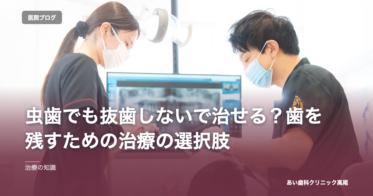 虫歯でも抜歯しないで治せる？歯を残すための治療の選択肢 のアイキャッチ画像